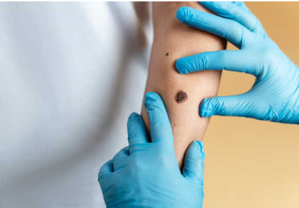 Everything You Need to Know About Safe Mole Removal